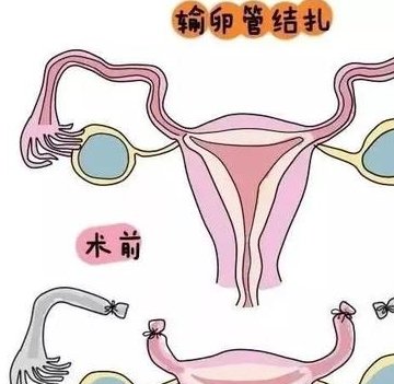 北京做试管婴儿可以报销了是真的吗？