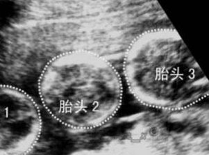 俄罗斯试管婴儿的价格与成功率